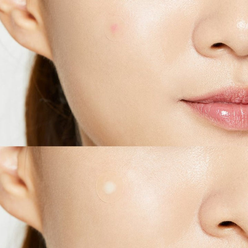 COSRXAcne Pimple Master Patches